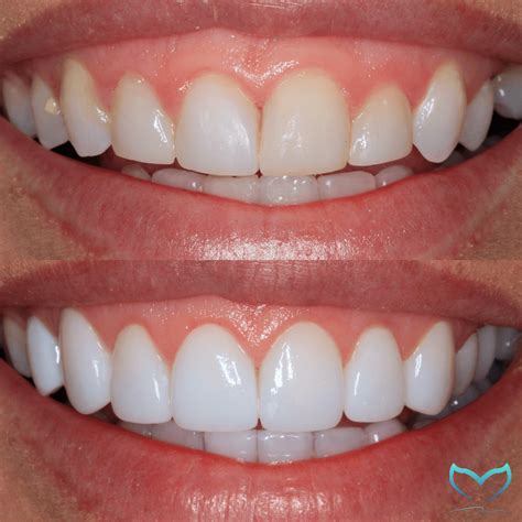 composite teeth veneers|Understanding Composite Veneers in Comparison to .
